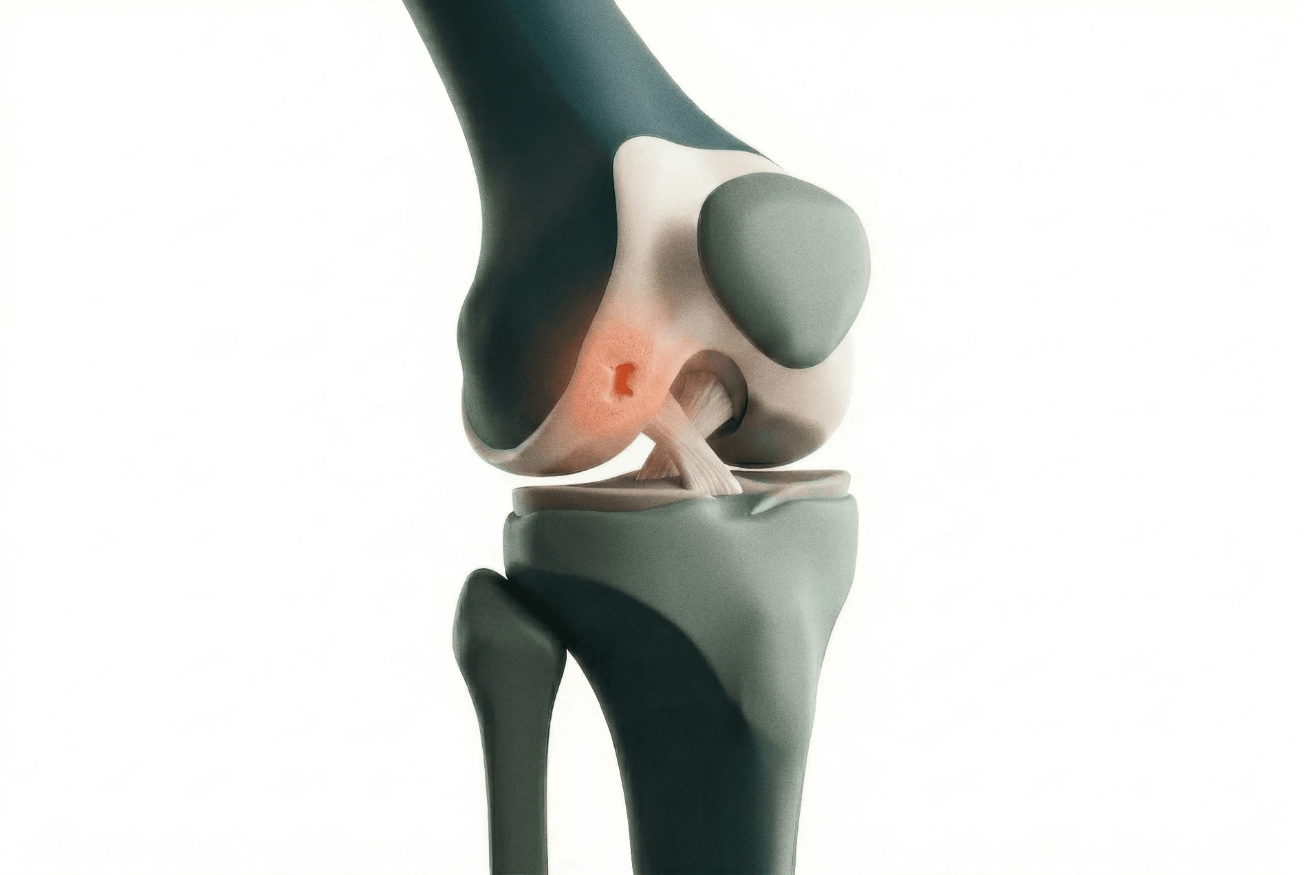 Adult Osteochondral Injury