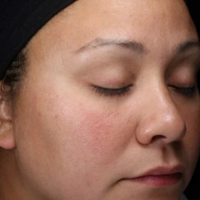 Before soothing anti-inflammatory treatment at The Vancouver Aesthetician — visible redness and reactivity on sensitive skin