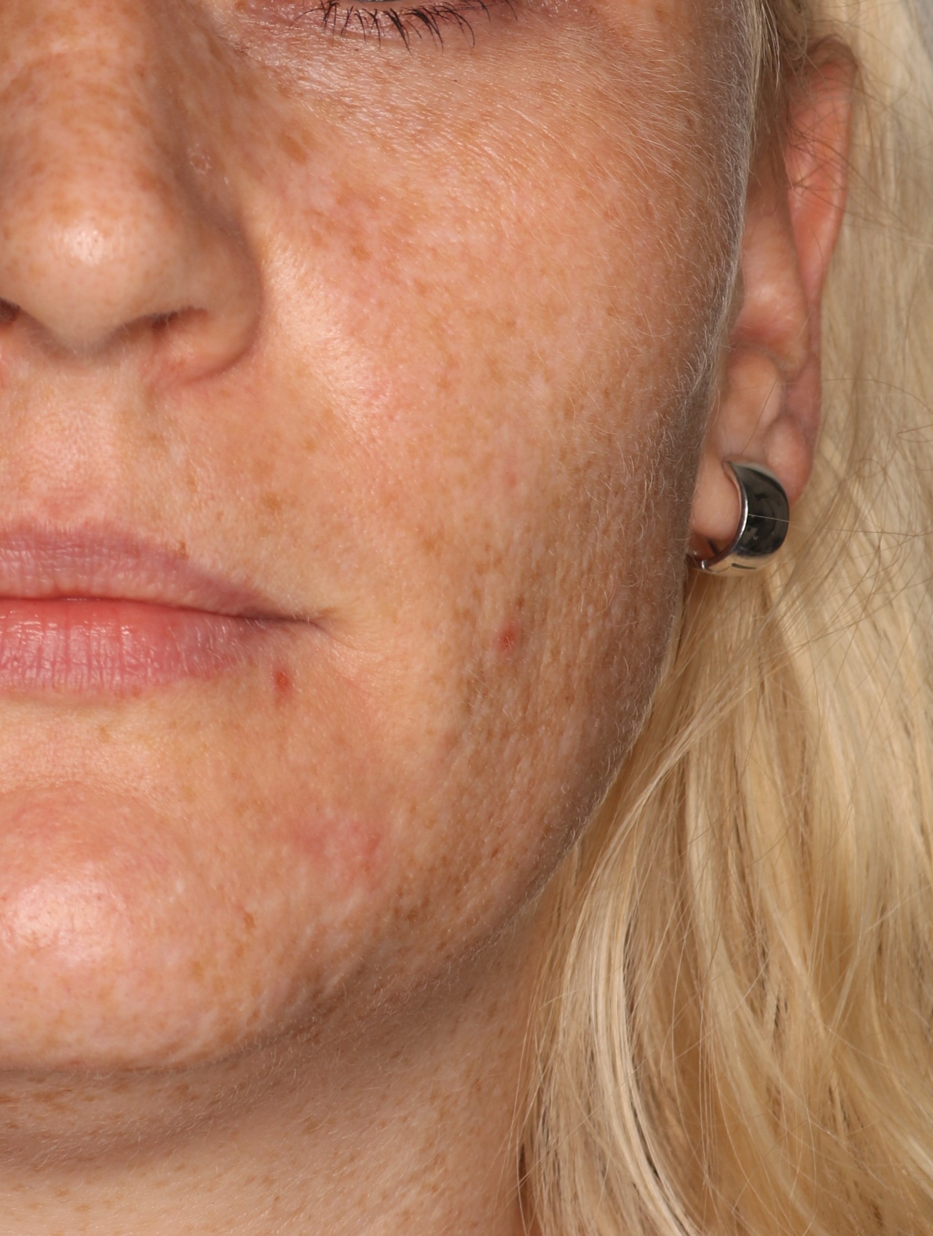 Efekt zabiegu Laser frakcyjny CO2 - Przed 1