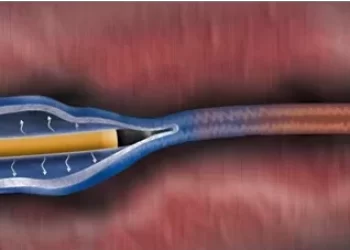 하지정맥류 치료_레이저, 고주파