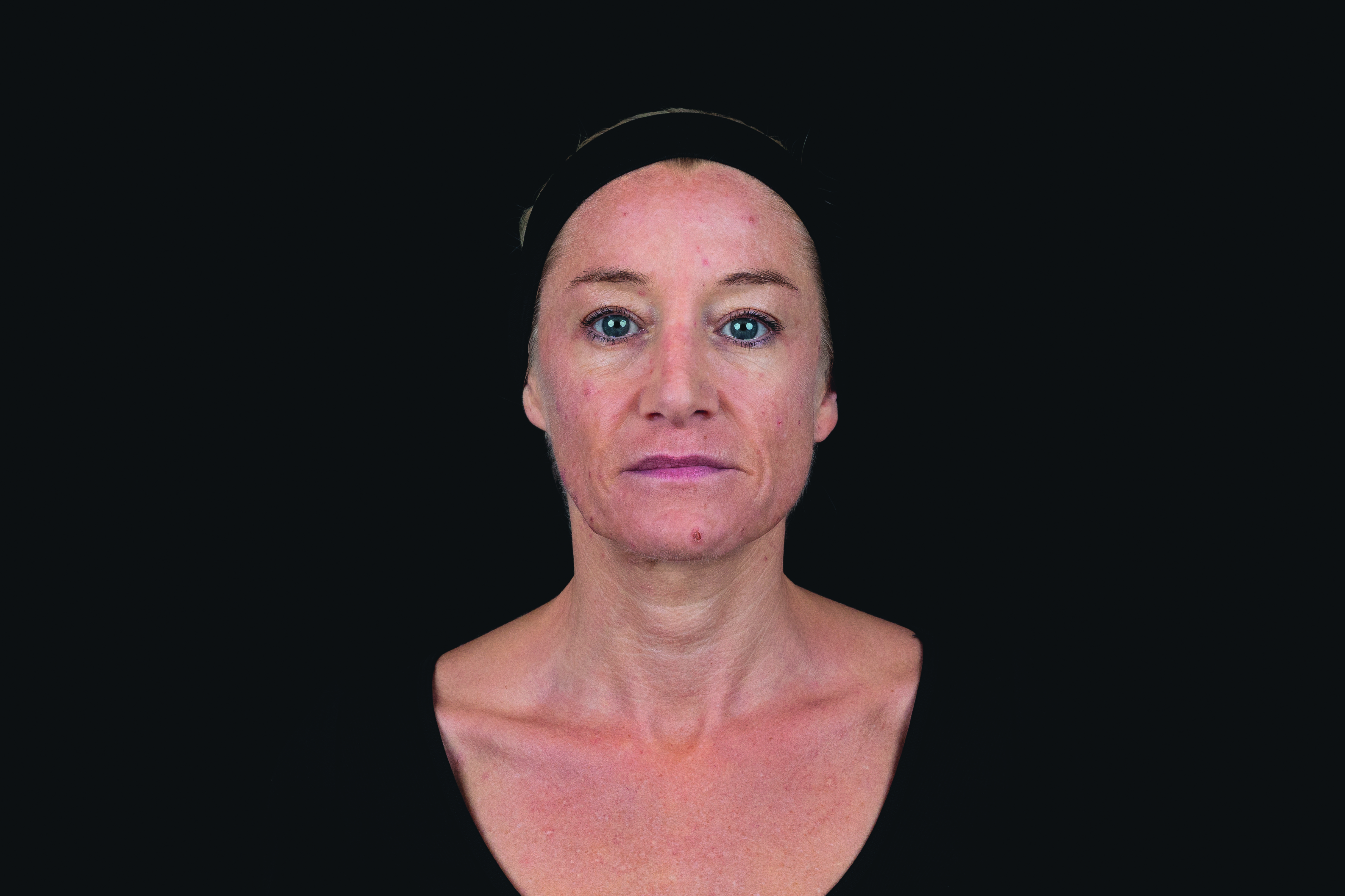 Before portrait of female model prior to Croma Saypha Volume Plus Lidocaine dermal filler