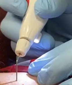 Clinician performing skin treatment using Plexr plasma pen.
