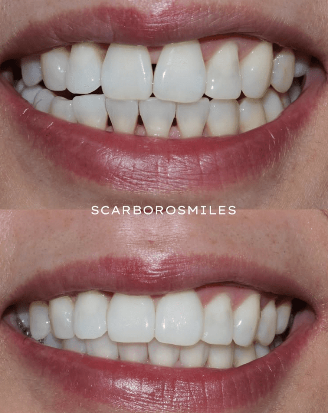 Before and After Dental Bonding at ScarboroSmiles Dental Clinic in Scarborough, ON | Best dentist in Scarborough.