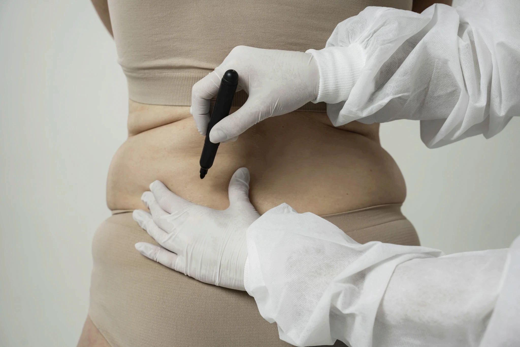 Liposuction