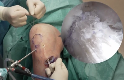 Anterior cruciate ligament (ACL) reconstruction