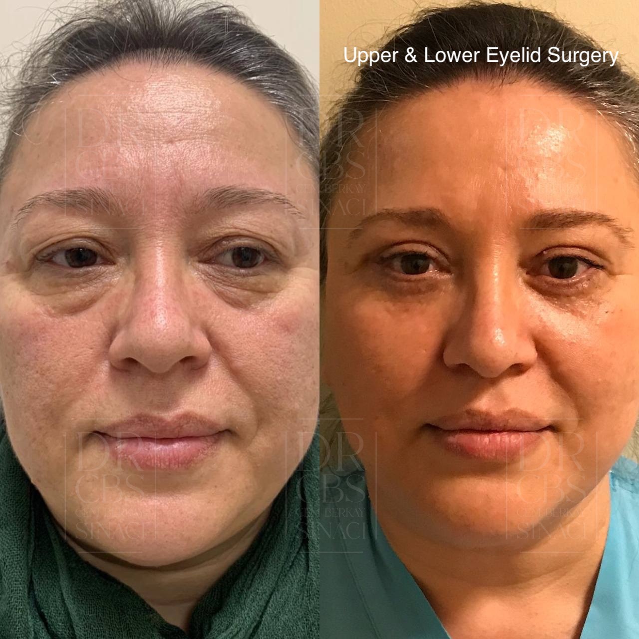 upper and lower blepharoplasty 3 weeks before after