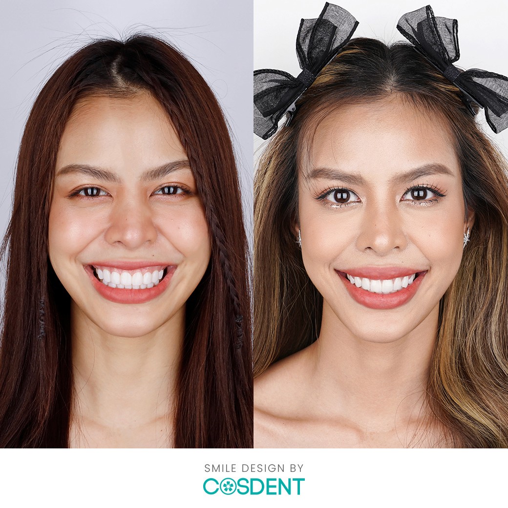 ผลงานการเปลี่ยนแปลงรอยยิ้มที่ COSDENT