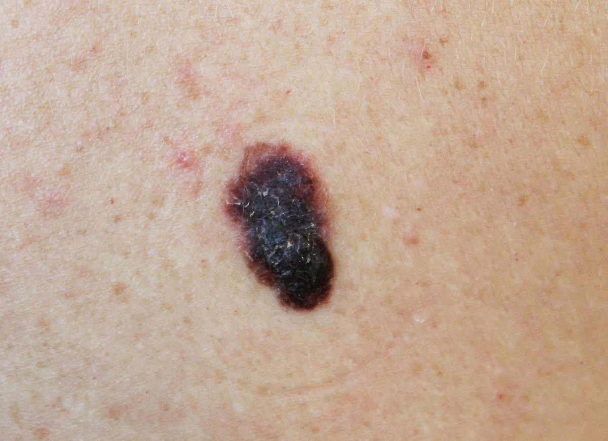 What Does Melanoma Look Like