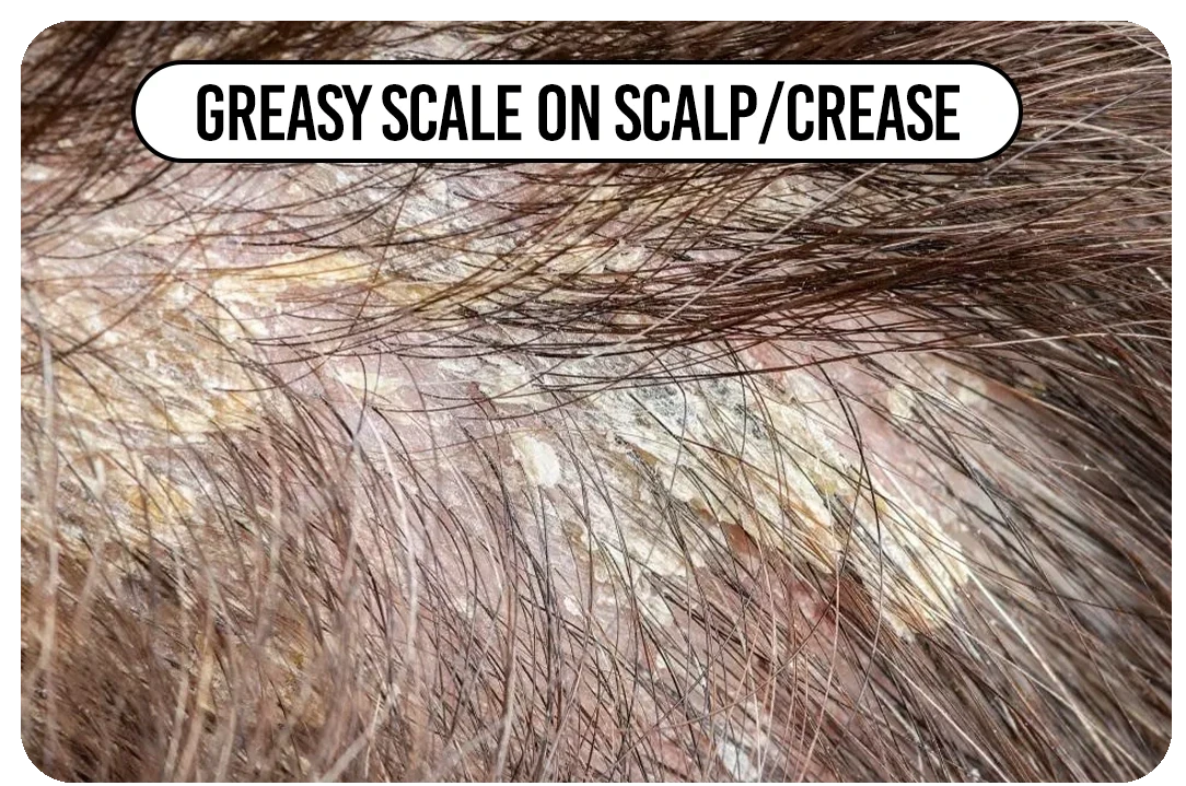 Greasy scale on scalp/crease