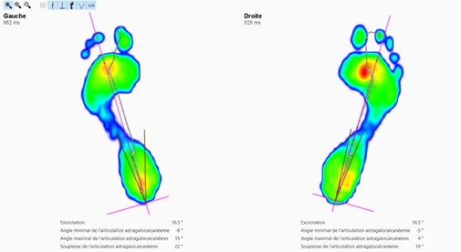 Empreintes montrant les pressions exercés sur la plante des pieds