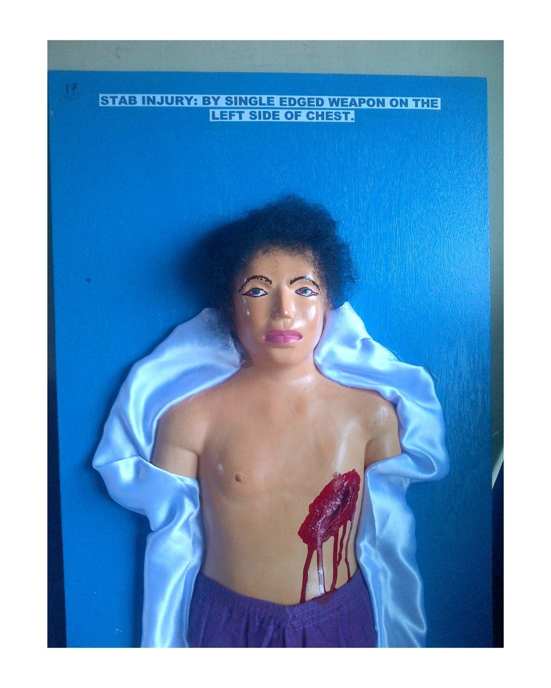 Stab Injury By Single Edged Weapon on the Left Side of Chest