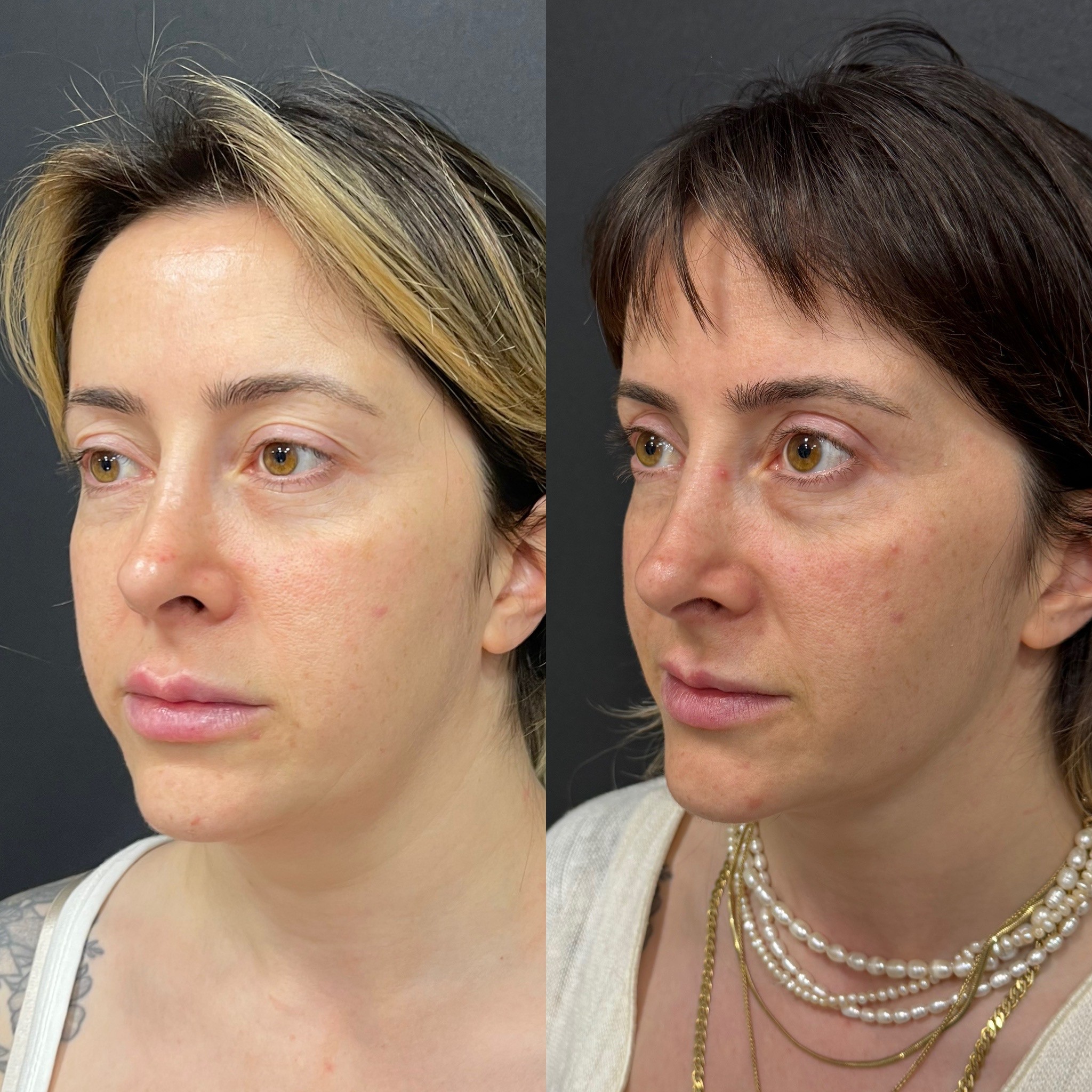 turkey neck deformity chin laser liposuction before after oblique view