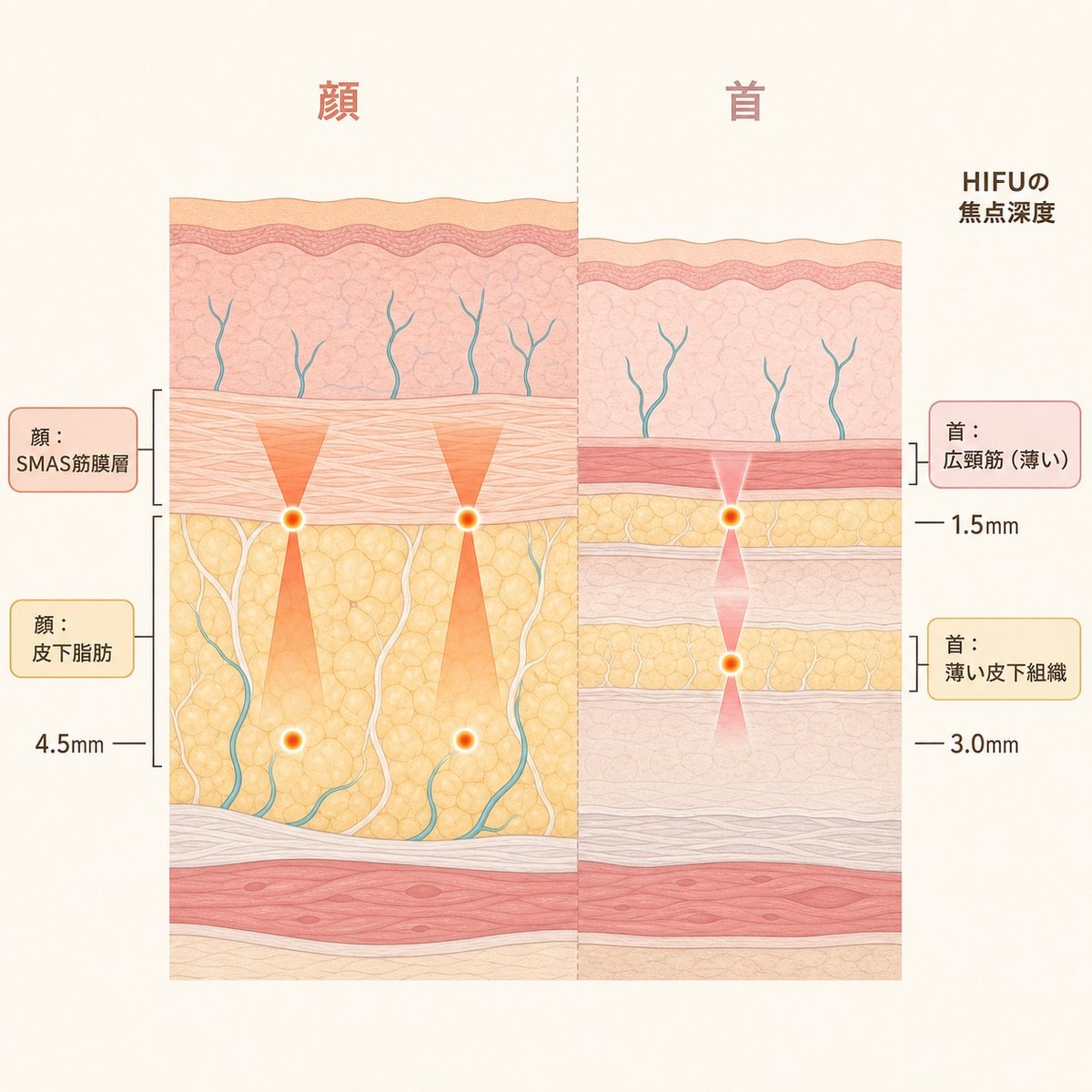 顔と首の組織層の深度構造の違いとHIFUの焦点位置の比較図