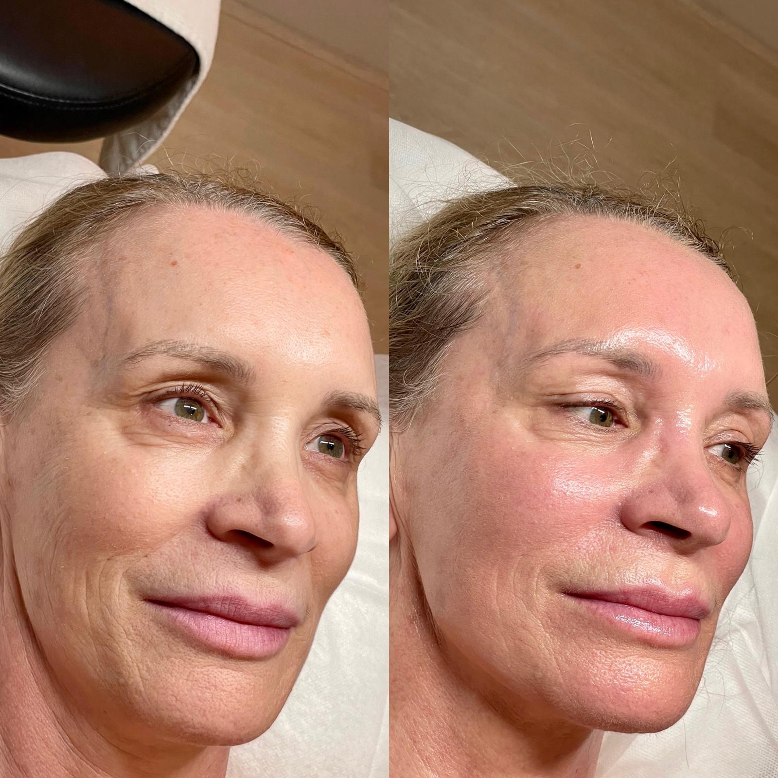 amirova firming facial