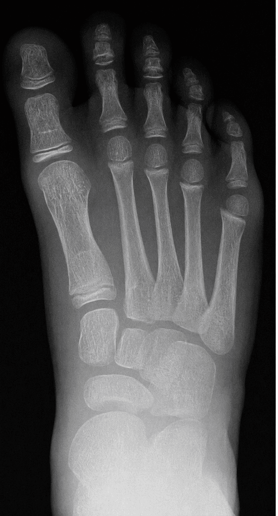 Radiografia dorsoplantare sotto carico del piede di un bambino