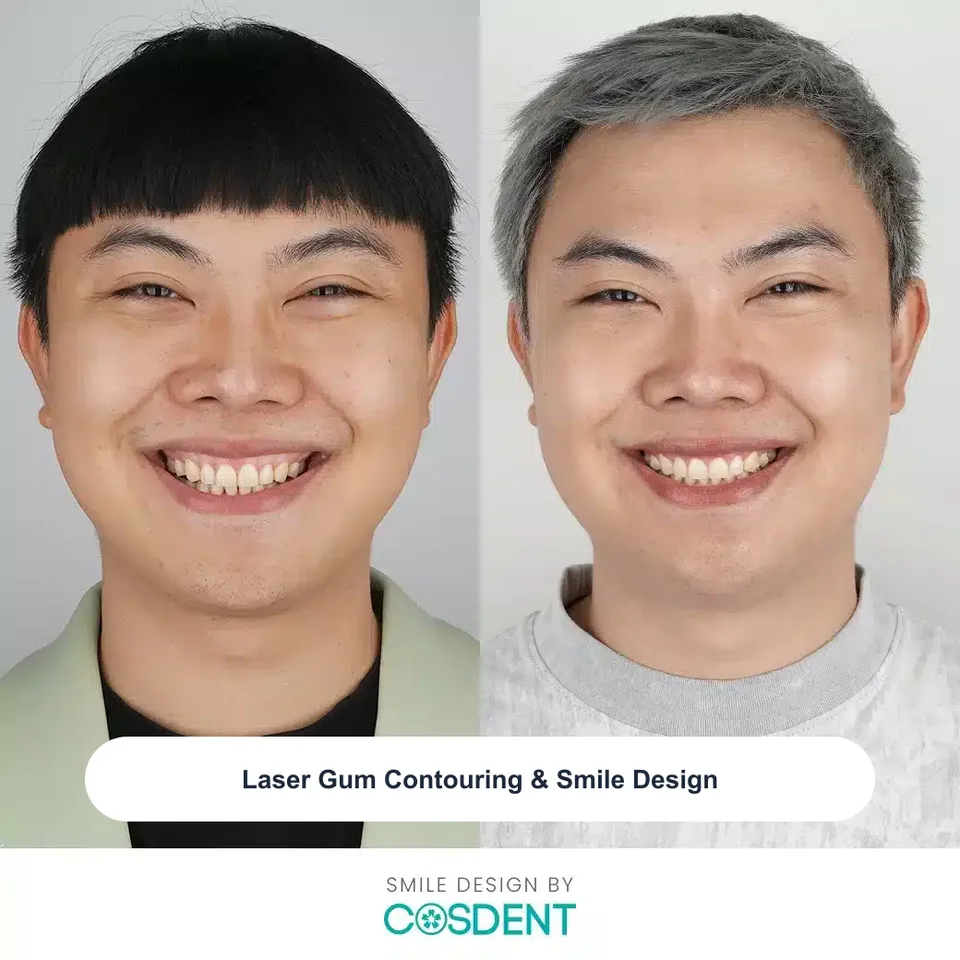 Before and after laser gum contouring and smile design at COSDENT Smile Design
