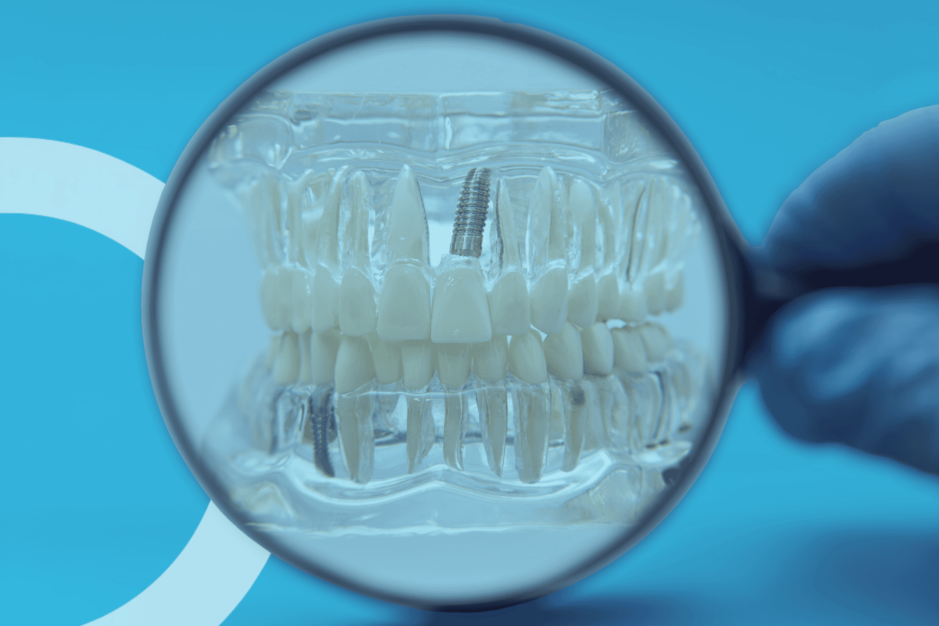 mano con una lupa apuntando hacia unos implantes dentales