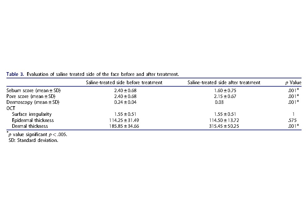 The efficacy of intra dermal injections of botulinum toxin in management of enlarged facial pores and seborrhea: A split face controlled study