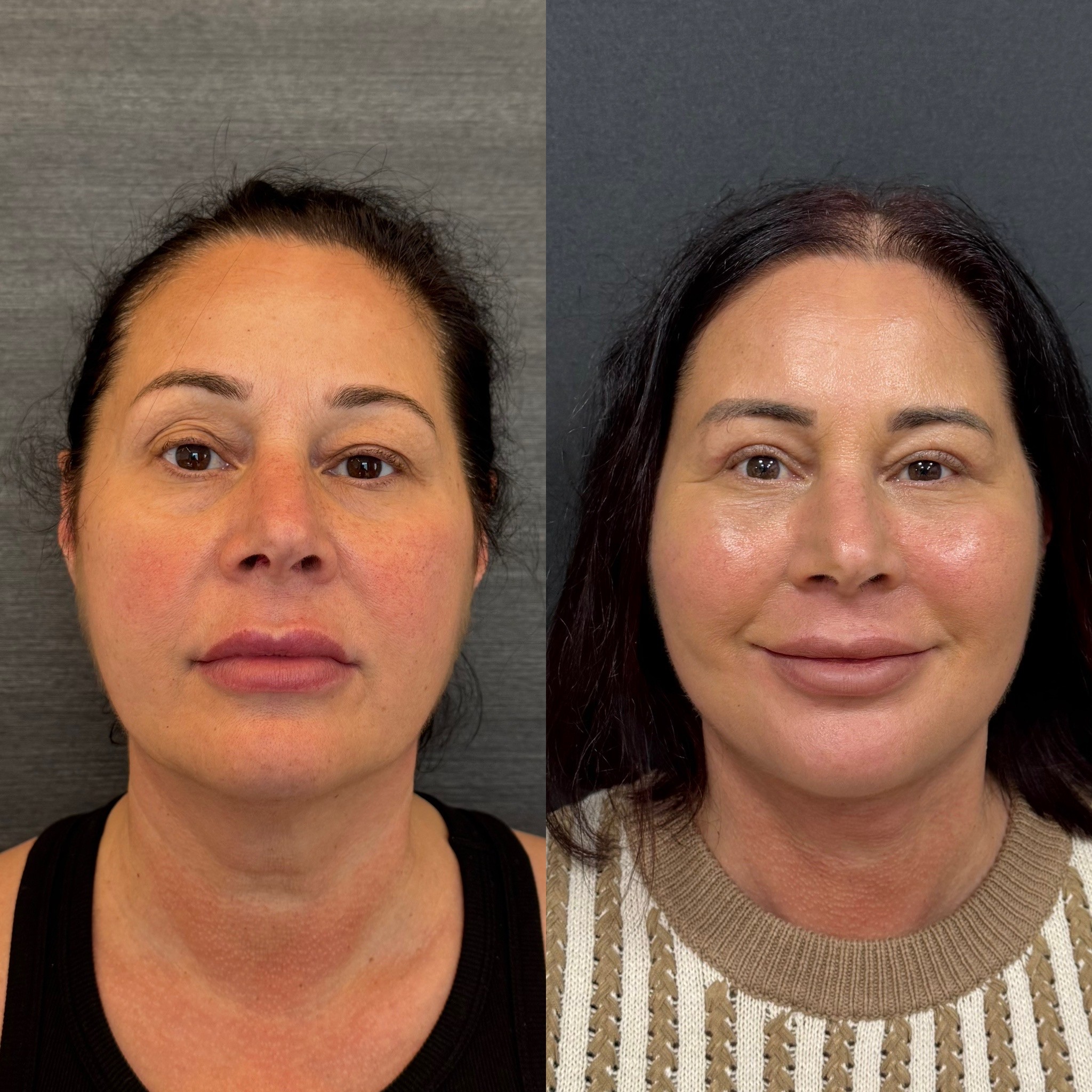 1 month before after result of deep plane face neck lift front view