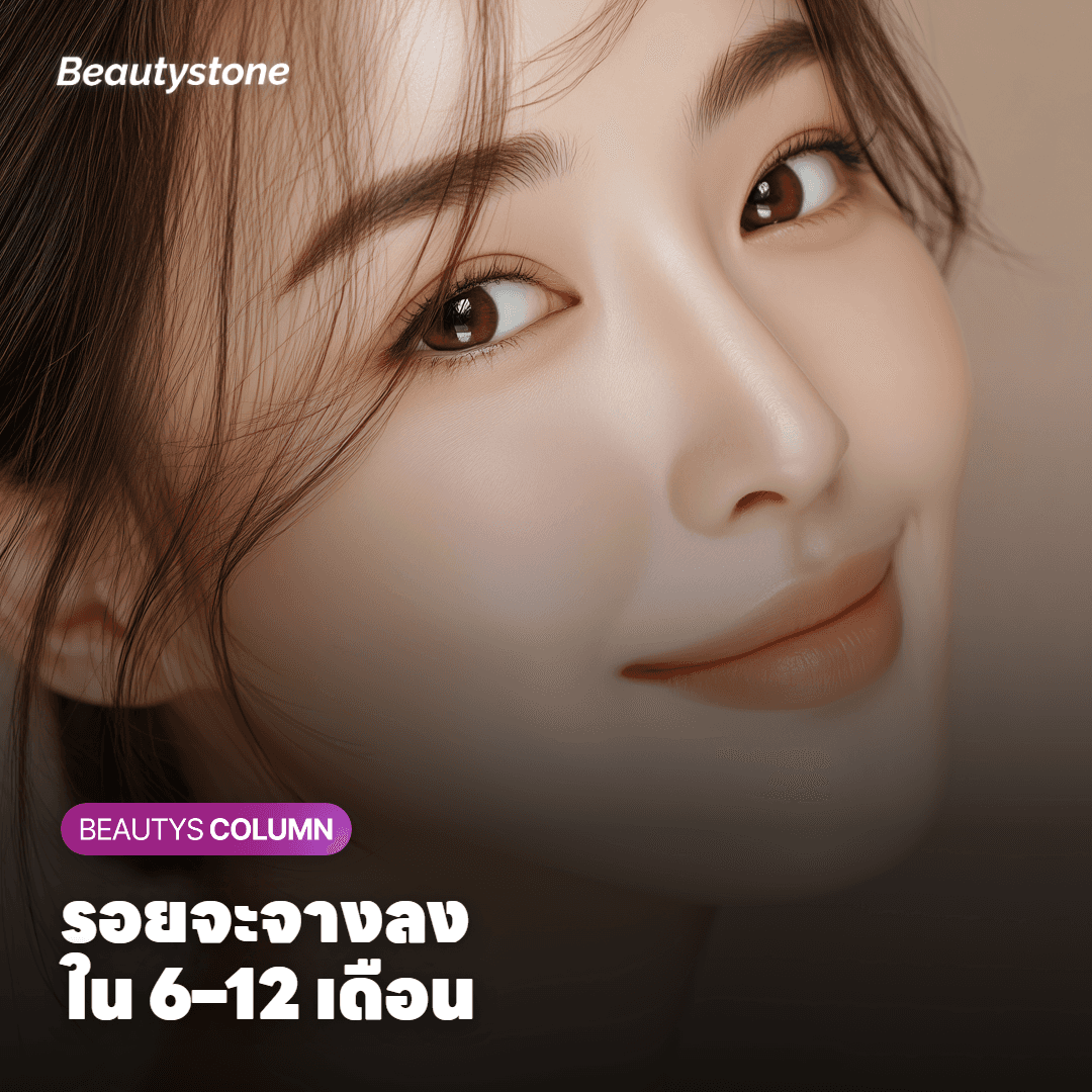 ระยะเวลาที่รอยดำที่ก้นจะจางลง