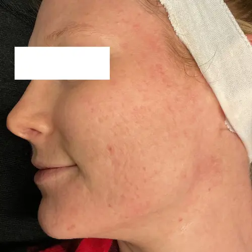 After microneedling and growth factor acne scar treatment at The Vancouver Aesthetician — severe pitted scarring and skin texture significantly improved and smoothed