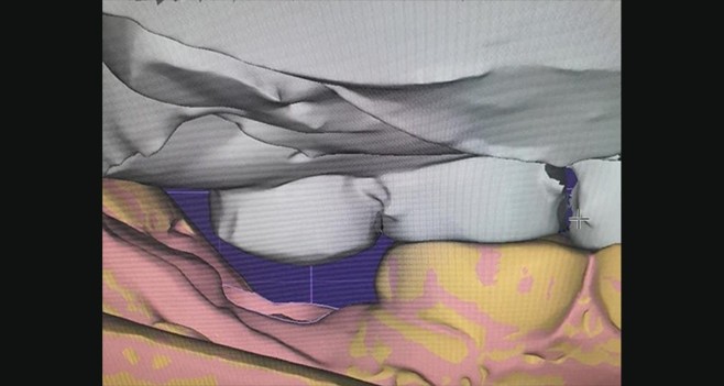 너무나도 부족한 수직고경