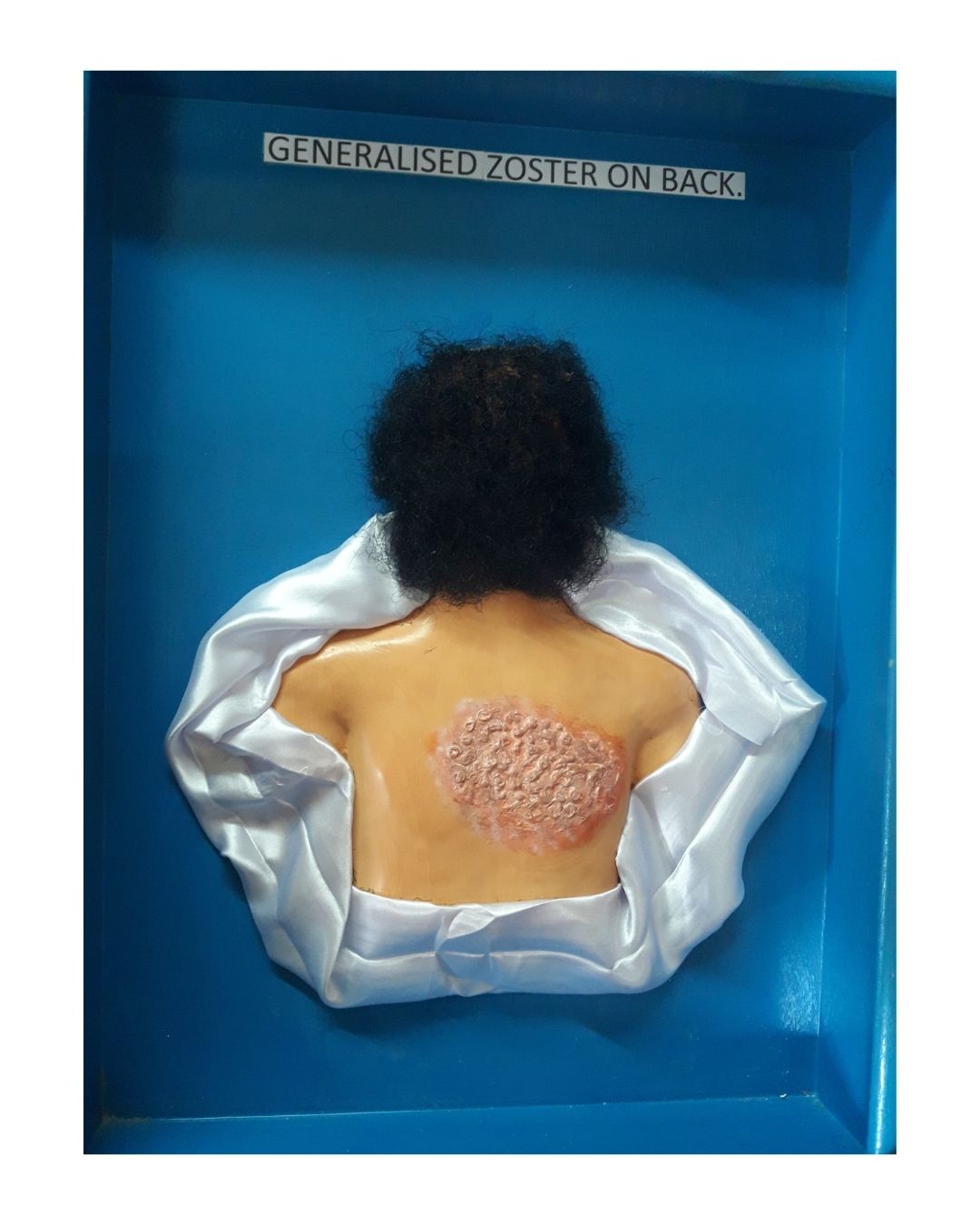 Generalised Zoster on Back