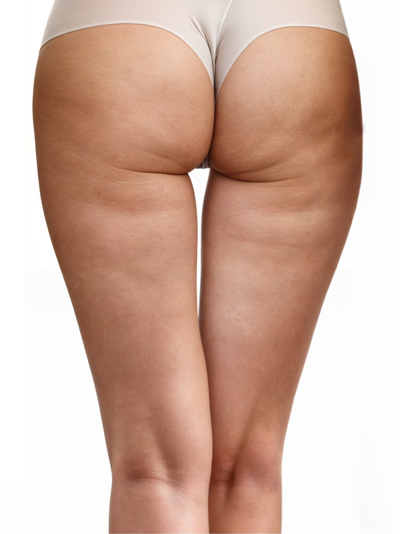 Before treatment photo showing the back of a person's thighs with visible cellulite, demonstrating typical skin texture and condition