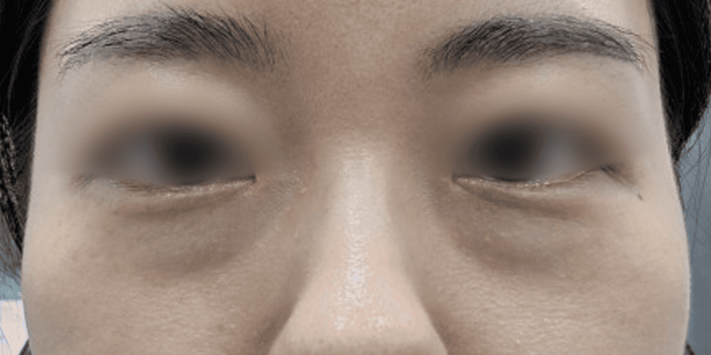 Undereye Filler - Before