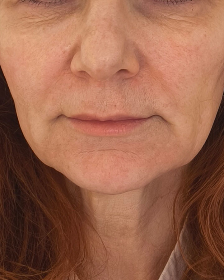 Ochabnuté kontúry tváre v oblasti sánky pred neinvazívnym liftingom