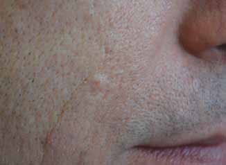 Figure 9: Sebaceous hyperplasia