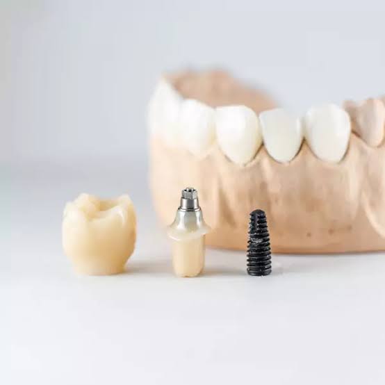 Patient placing a clear dental aligner over her teeth
