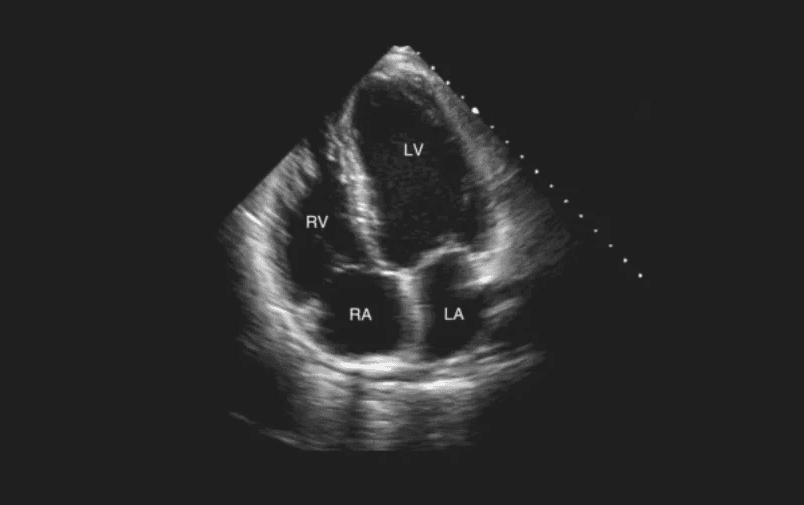 Apical four (AP4) view of echocardiogram: Four chambers of the heart