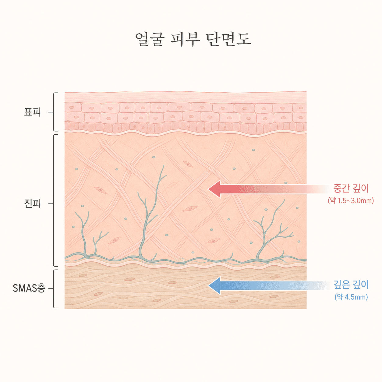 써마지가 닿는 진피층과 울쎄라가 닿는 더 깊은 층