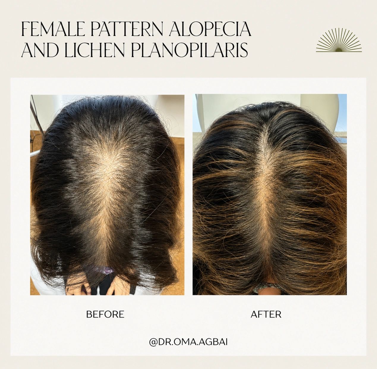 Female pattern hair loss and lichen planopilaris: before treatment on the left; after treatment on the right.