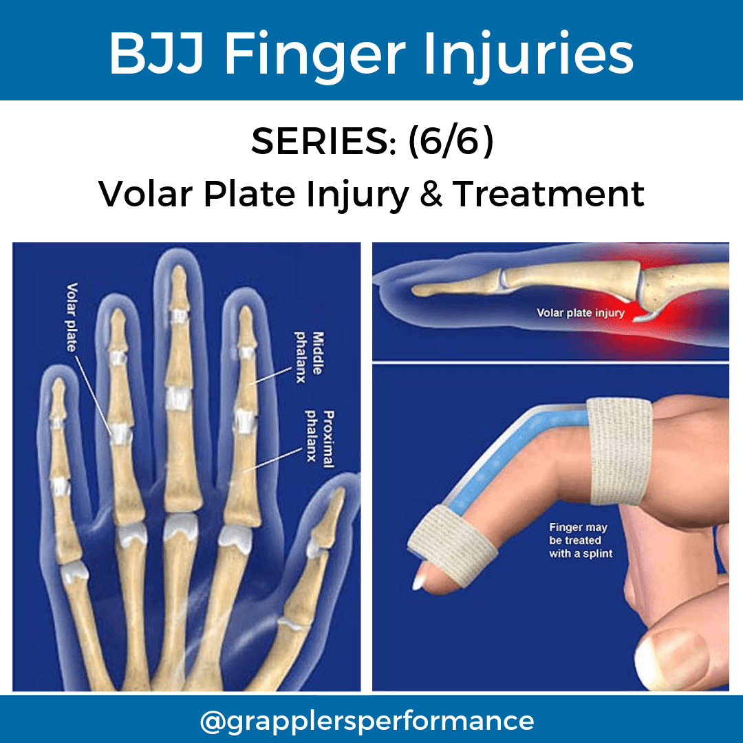 Diagram of volar plate injury showing hyperextension at the PIP joint with damage to the thick ligament on the palm side. The finger bends backward abnormally at the joint.