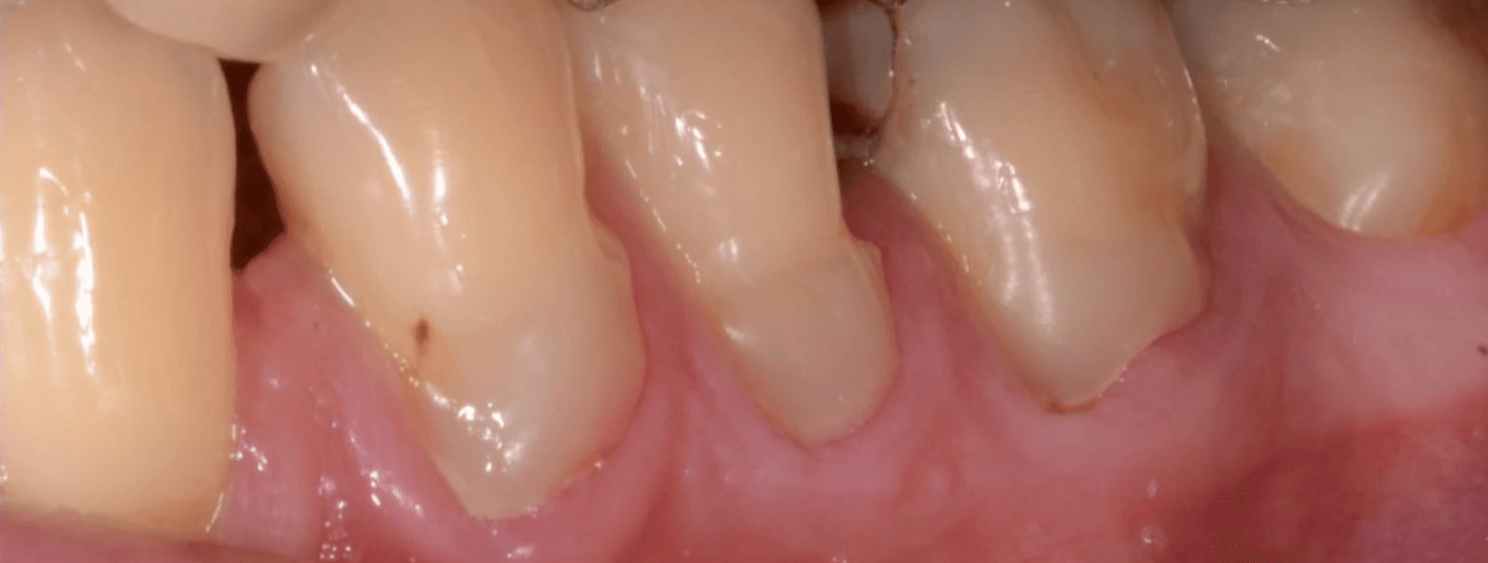 Before removal of composite and restoration of the gumline. Composite resin clearly obstructing and damaging the gumline of the patient.