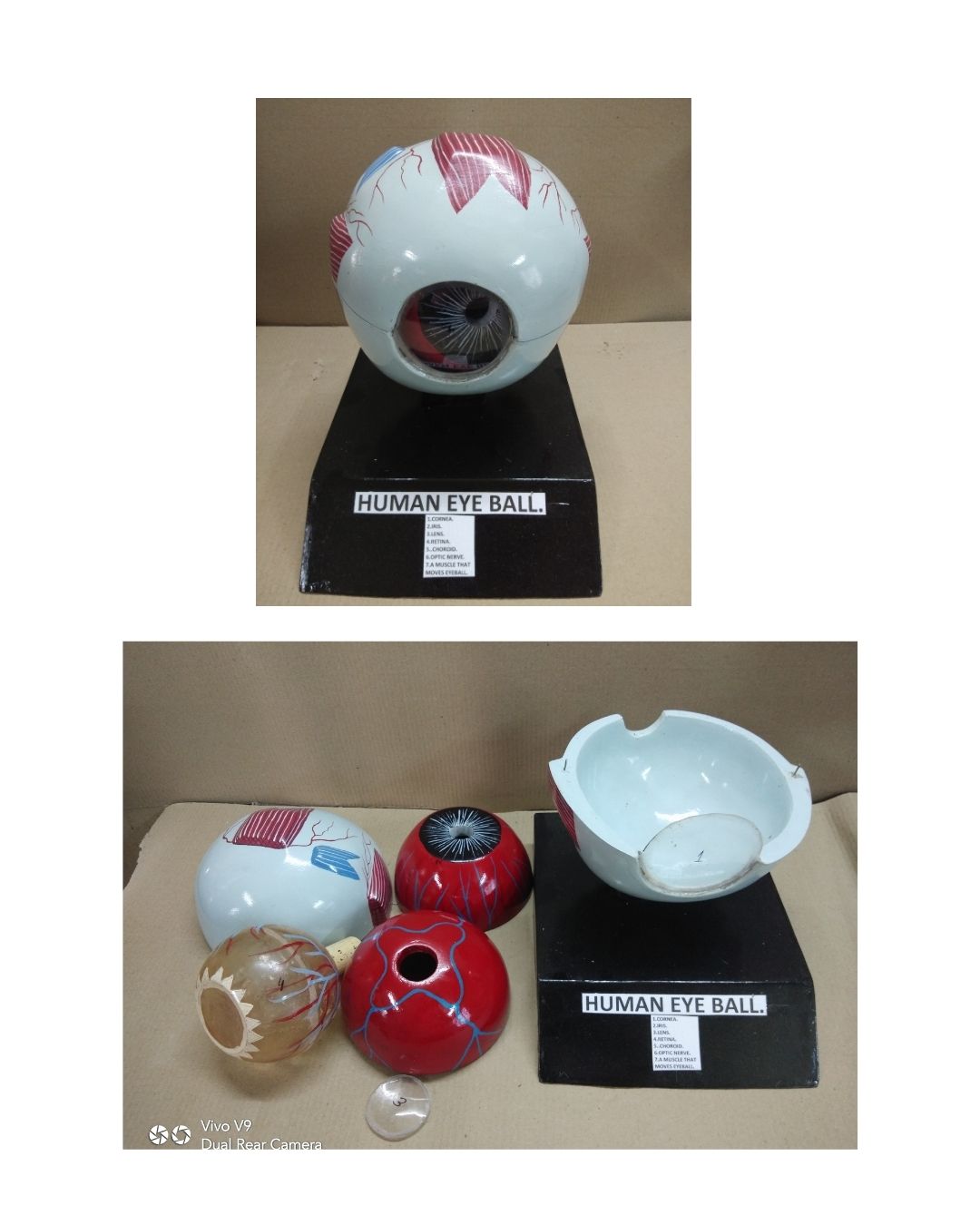 Enlarged Eye in Orbit