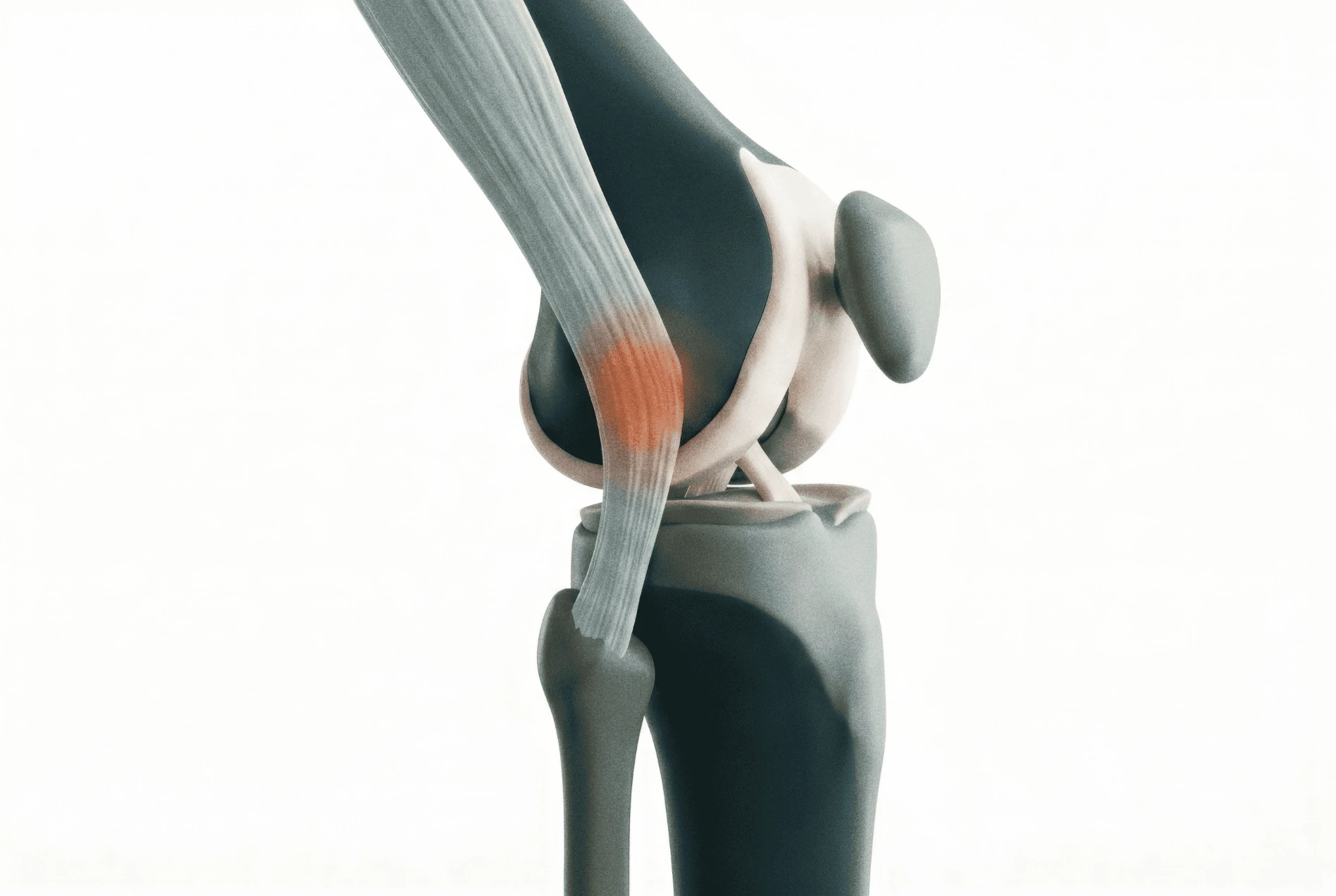 Adult ITB Syndrome