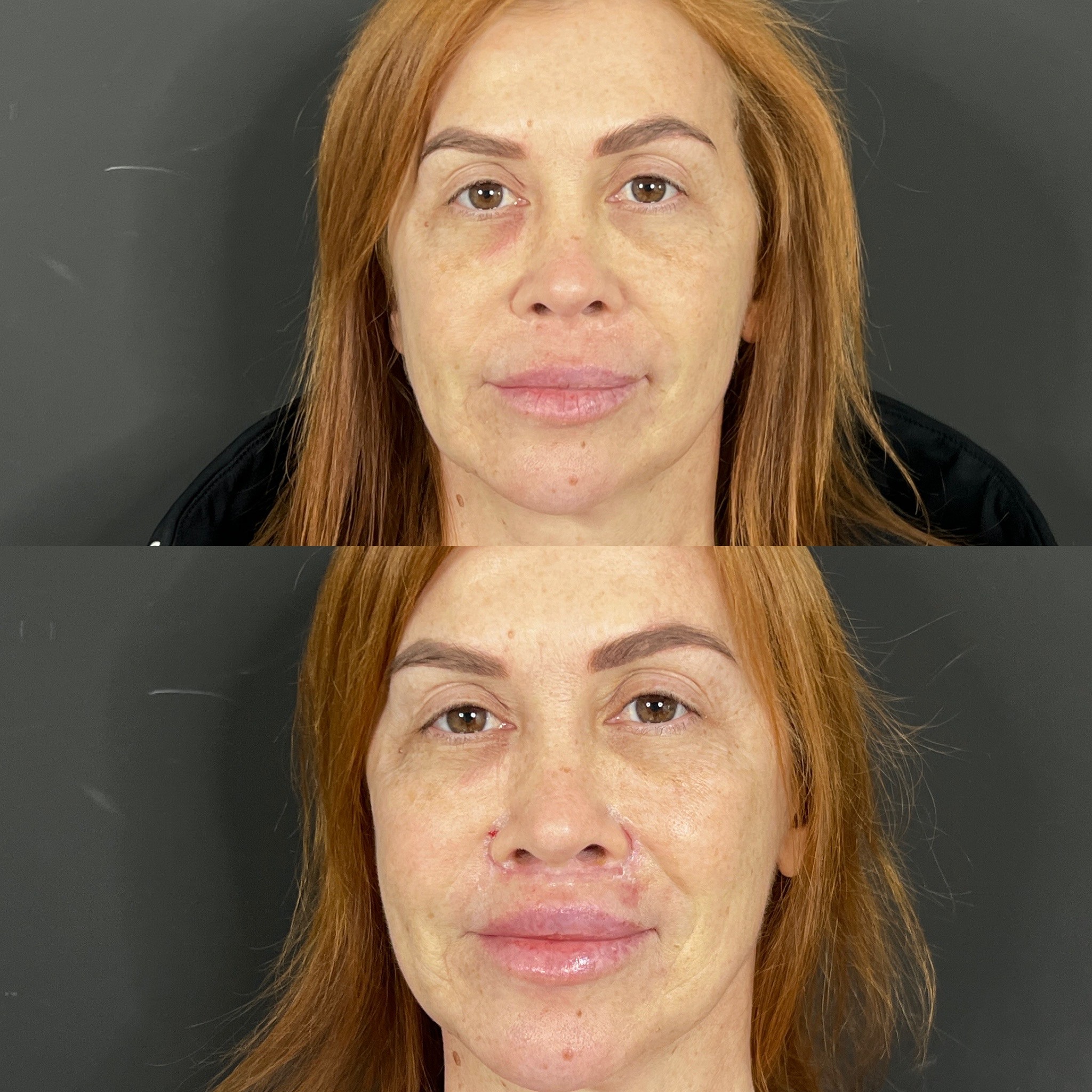 15 days result lip lift surgery