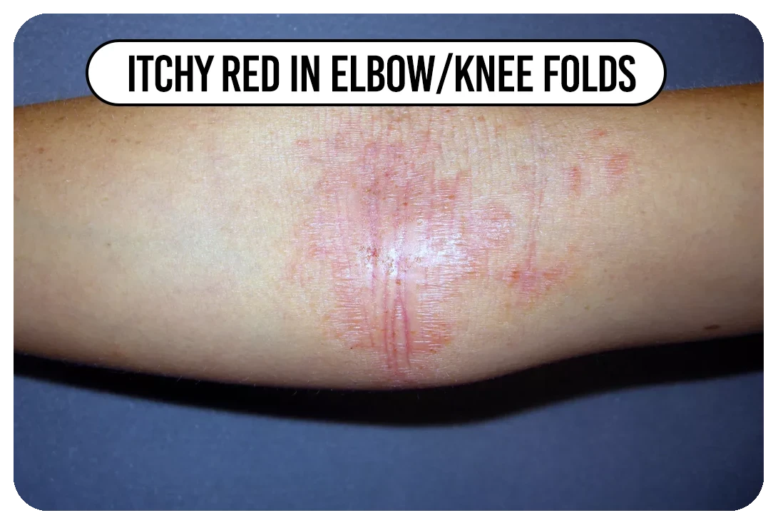 Itchy red in elbow/knee folds