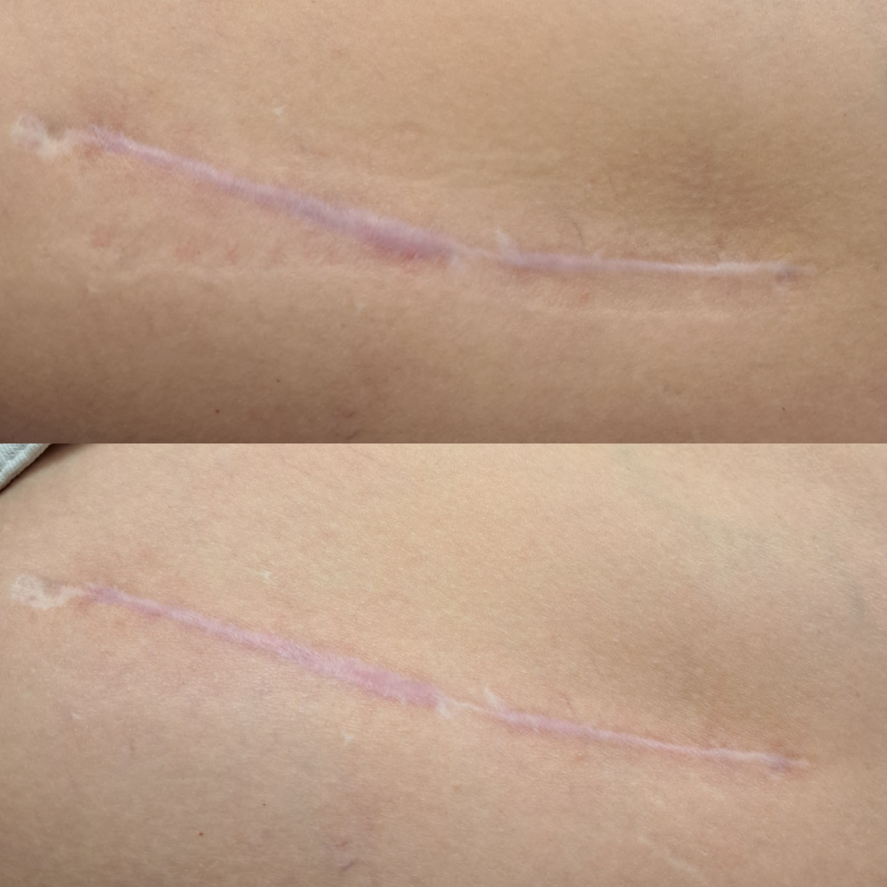 Neuroscars terapia_blizn_estGen_szczecin_praca_z_bliznaÌ¨_zabieg_na_blizny_efekt_jednego_spotkania_blizna_przerostowa_leszczenko