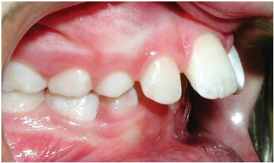 protrusion