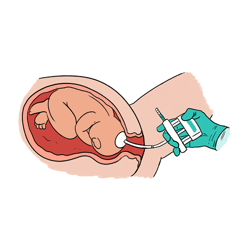 A cross-section illustration of a white suction cup placed on the baby's head in the womb. It is attached by cable to a manual device the medical professional supporting the birth squeezes to guide the baby out of the vagina.
