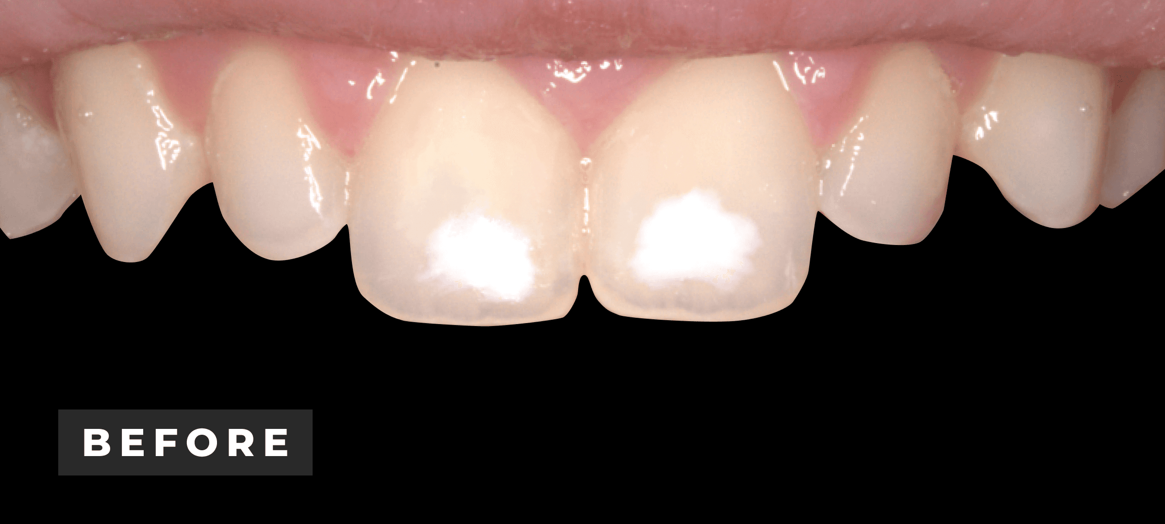 Before image of zoom whitening & resin infiltration