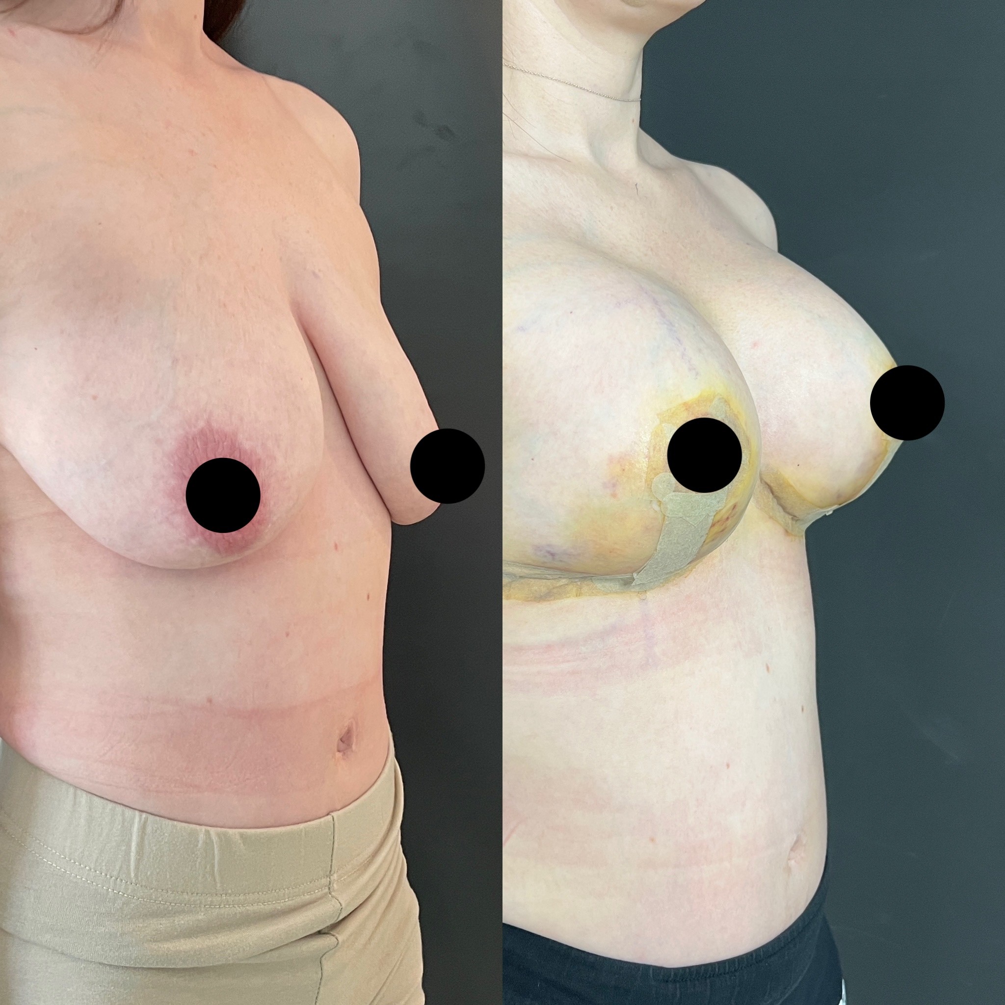 tuberous breast deformity before after 5 days result right oblique view