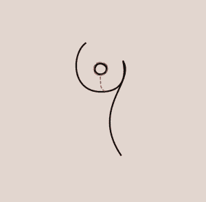 Illustration av Shortscar-snittet på ett bröst