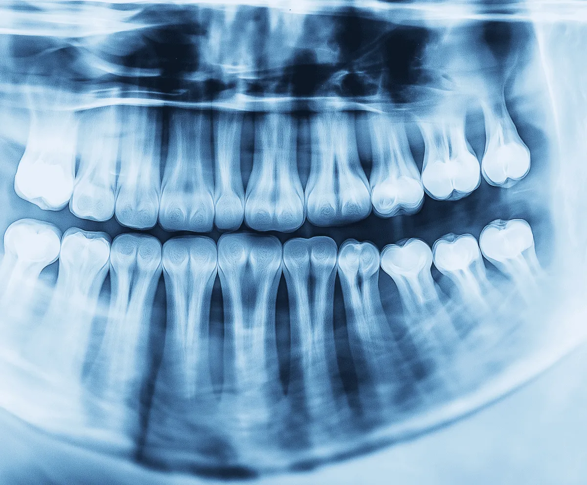 Dental X-Rays at Midtown Dental Studio on Eglinton in Midtown Toronto, Ontario | Best Dentist in Midtown Toronto, Ontario