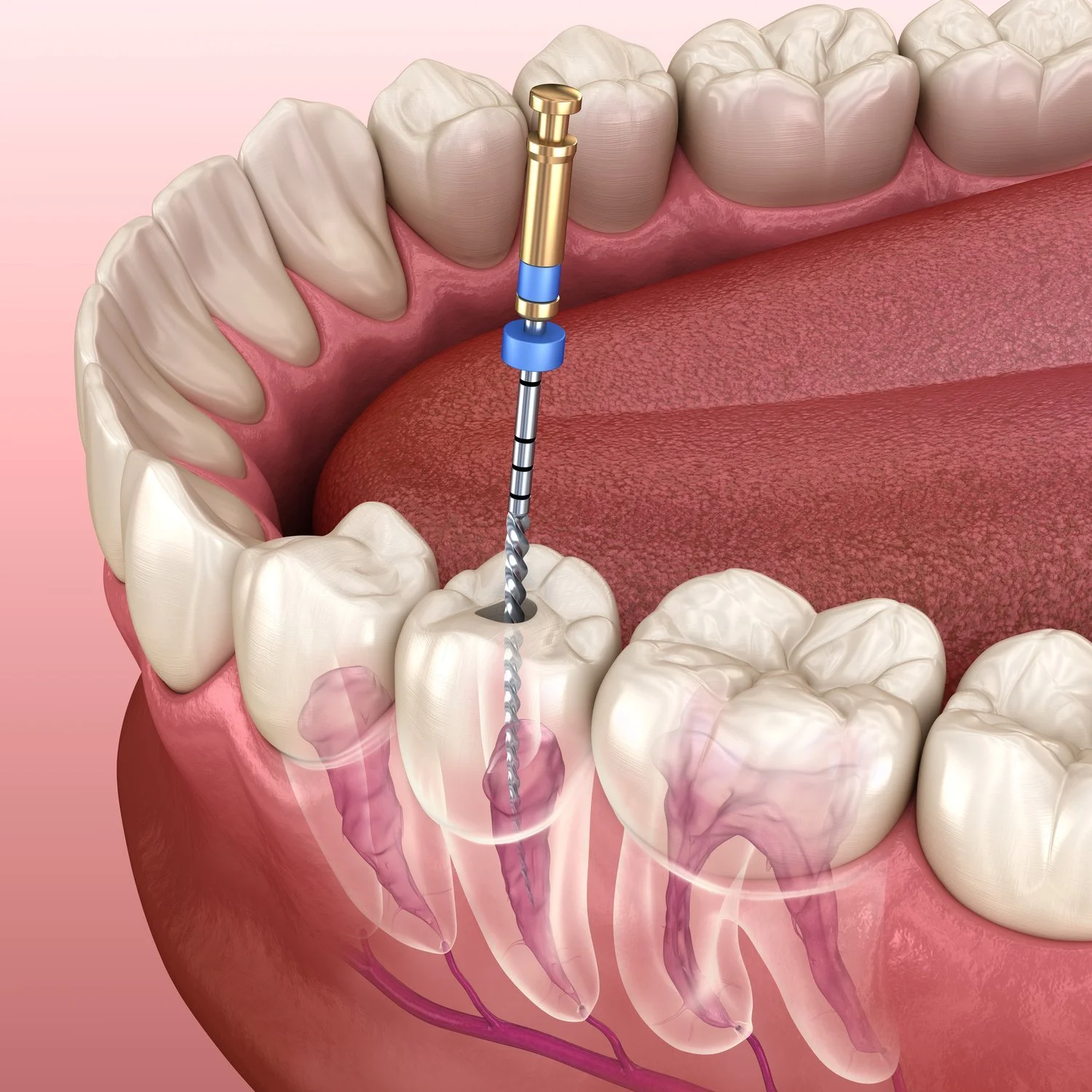 Root Canal Rochelle Park