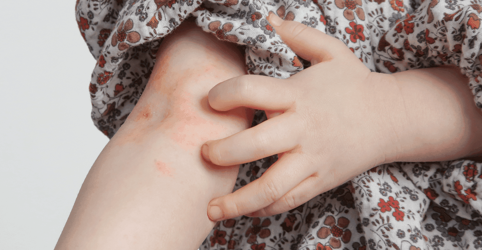 child with eczema on arm